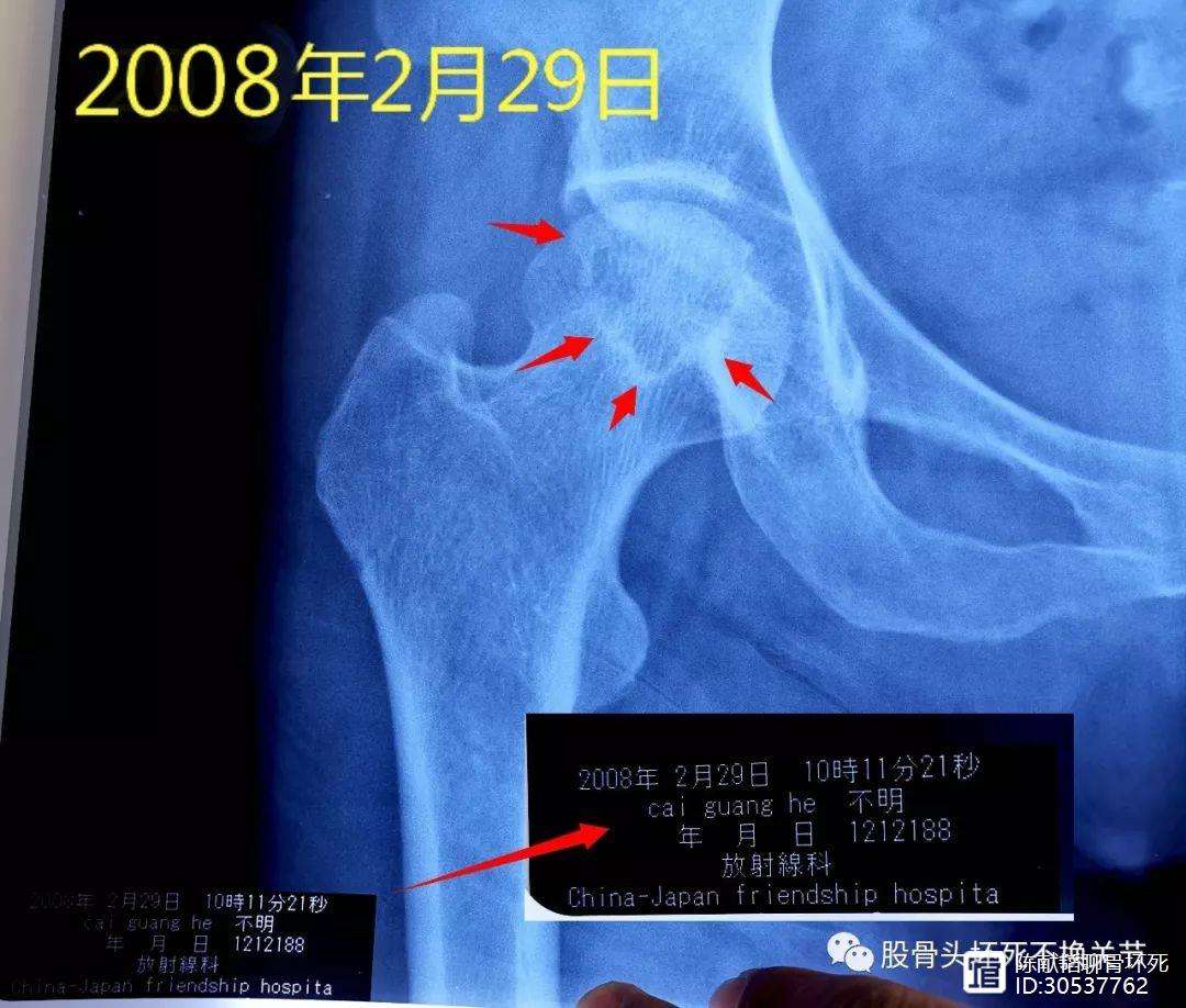 长沙人工骨头医保报销多少(人工骨头医保报销多少比例)